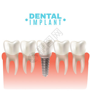 牙科种植模型侧视海报牙科种植模型特写剪侧视图教育医学海报矢量插图图片