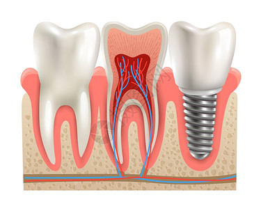 牙种植体解剖特写模型牙种植体真实牙齿解剖特写切段模型侧视真实向量插图图片