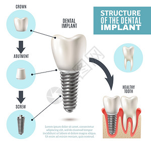 牙科种植结构医学信息海报牙种植体结构医学图示教育信息海报与磨牙替代健康工具模型矢量插图背景图片