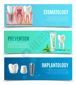 种植牙素材种植牙3个水平横幅医疗口腔保健3个水平横幅预防口腔科牙种植体书签孤立矢量插图插画