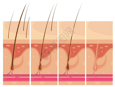皮肤元素脱发皮肤的脱发故事板作文与轮廓观视图秃头头皮皮肤信息图像矢量插图插画