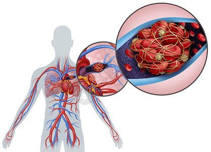 血栓栓塞肺栓塞血凝块是一种疾病三维插图元素背景
