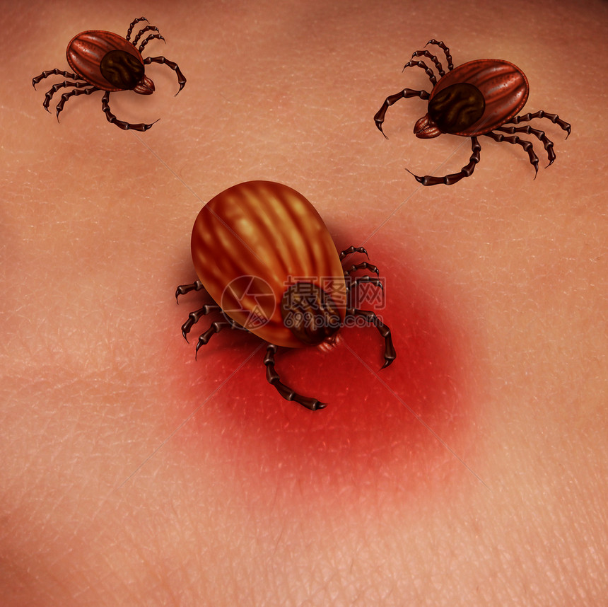 淋巴病人类滴子概念是雌昆虫喂食人体皮肤上的血液是细菌感染的保健问题和自然发现的滴子感染危险图片
