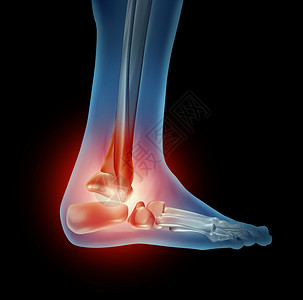 脚踝疼痛有行走身体骨骼部分有红色骨头侧视关节有炎症因鞋子坏或发生事故造成骨折共同受伤背景图片