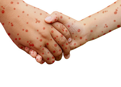 麻疹疾病宣传图背景图片