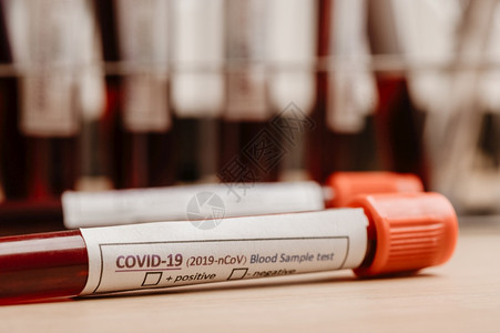 为诊断2019年新科罗纳疾病从具有实验室背景的进行验血检查和实验样本图片