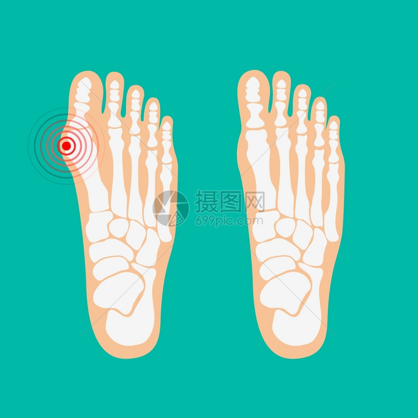大脚趾畸形足保健矢量插图图片