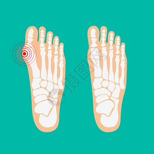 脚踝关节大脚趾畸形足保健矢量插图插画