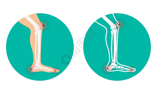腿部疼痛膝盖脚跟矢量说明高清图片