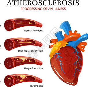 内皮血管硬化血栓解剖图设计图片