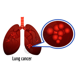酶肺癌图示卡通风格插画
