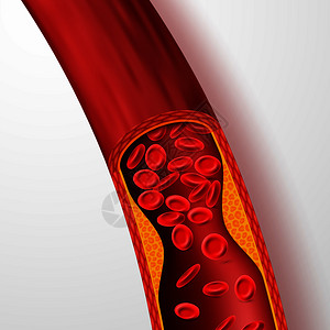 阻塞的止血管胆固醇清动脉和胆固醇血清3静脉和凝固病媒说明医疗动脉血液胆固醇疾病阻塞流动循环血液容器胆固醇血清动脉和胆固醇血清说明插画