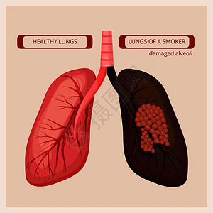 吸烟者肺病插画