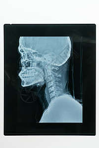 病人头颅和骨的医学x射线图像图片