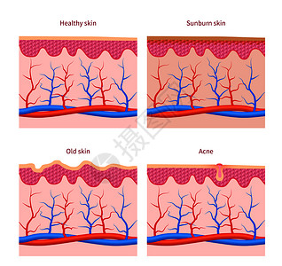 脓疱皮肤类型和健康晒伤和老皮肤痤疮向量集人体皮肤层插图皮肤类型健康晒伤和老痤疮向量集插画
