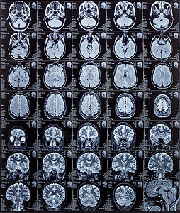 人类大脑的磁共振摄影图图片