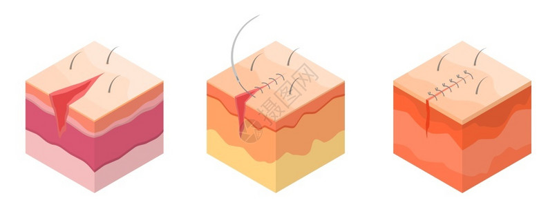 手术缝线外科缝线图标集外科缝线矢量图标集等用于在白色背景上隔离的网络设计外科缝线图标集等量风格插画