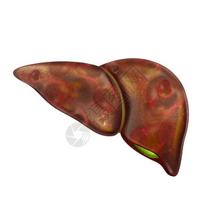 肝脏脂肪疼痛和硬化癌症胃病肝炎症高清图片
