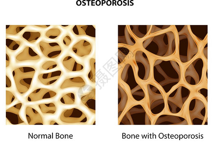 骨骼保健普通骨骼和与质疏松插画