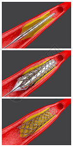 支架置入术安装支架的气球血管成形程序背景