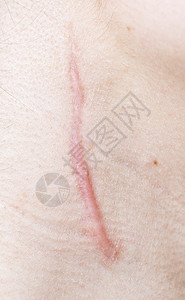 疤痕贴人类皮肤上的伤疤背景