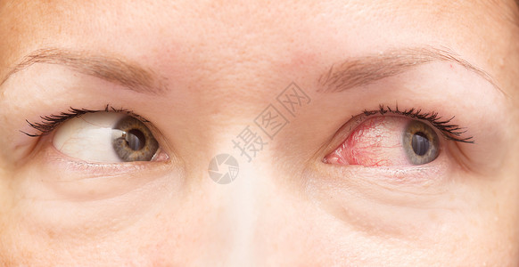 带血丝眼球健康和刺激红眼的特写背景