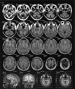 大脑X射线胶片图片