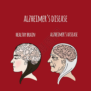 预防盲症阿兹海默症病症图插画