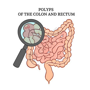 肠息肉结肠医学解剖插画