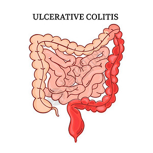 肠胃解剖 溃疡性发红高清图片