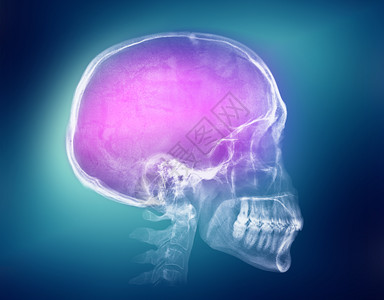 彩色背景上的人类头骨x光图像颅骨x射线图像图片