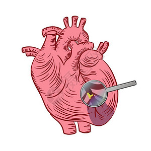 瓣膜心肌梗塞医学教育图心脏插画