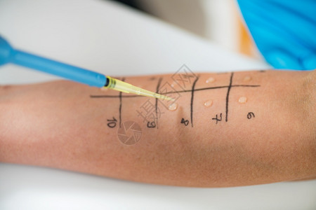 医生给皮肤刺过敏测试背景图片