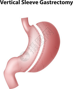 垂直袖子胃切开插图背景图片