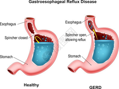胃食管反流肠胃呼吸回流疾病设计图片