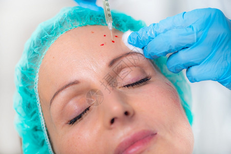 中年妇女接受血浆丰富的小板以减少皮肤皱纹口服注射治疗面部图片