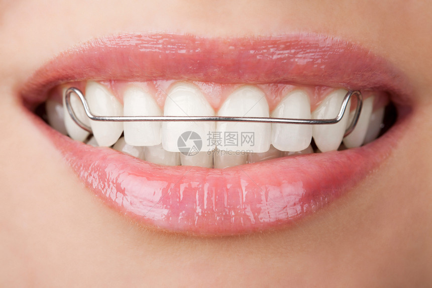 带牙的齿有预留剂图片