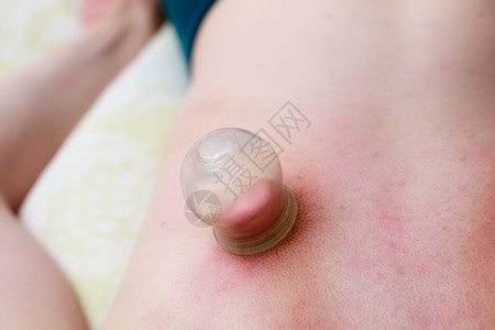 替代医药保健消防检查程序接受真空按摩治疗的妇女背部的详情图片