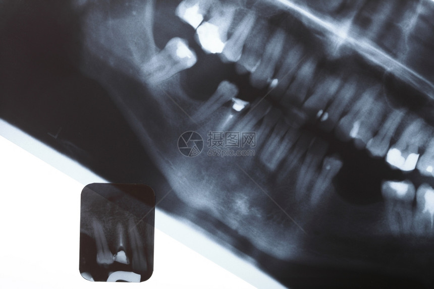 对人类牙齿进行全景和详细的X射线图像扫描图片