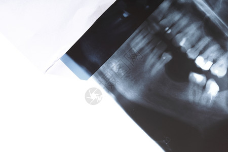 人体牙齿详细X射线图像扫描图片