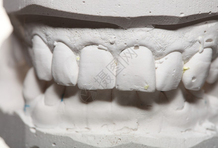 石膏模型人类下巴形态学假牙试验室技术图片