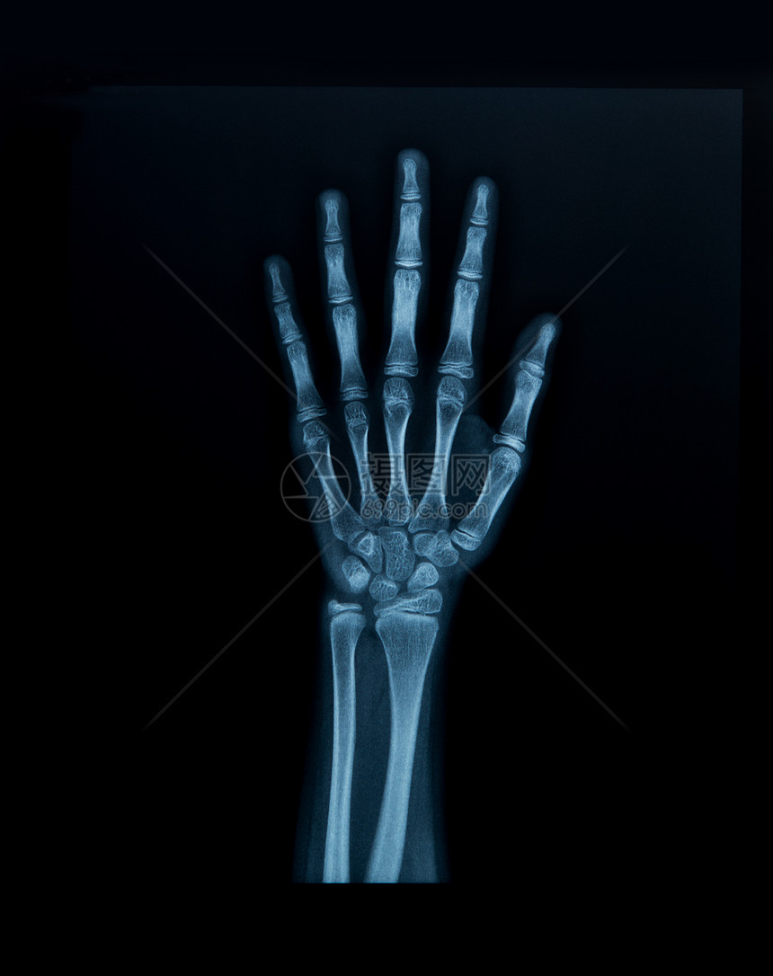 X射线手图片