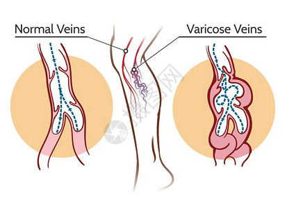 栓灭静脉变异说明血管腿血管健康说明和栓病说明插画