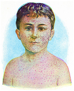 麻疹古老的刻字插图背景图片