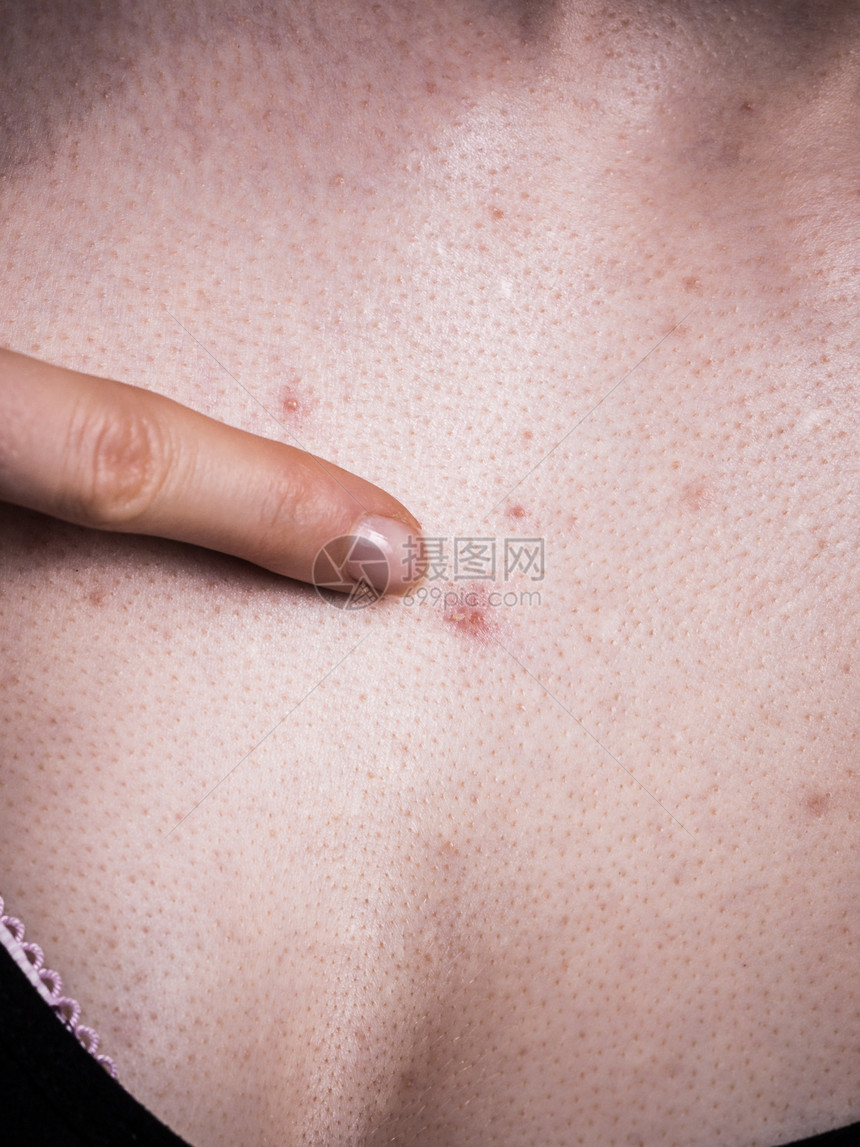 胸口有皮条红斑点的妇女胸口有红斑点的妇女胸口有红斑点的妇女图片
