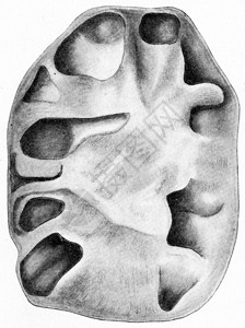 黄热病肾脏长期上升的肺结核刻有古老的图例图片