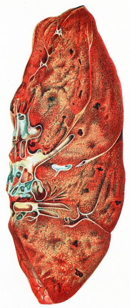 肺部炎古老的雕刻插图图片