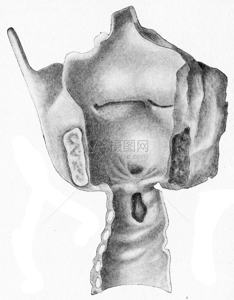 古草老雕刻的插图在结晶后造成创伤和局部喉硬化图片