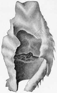 Perichondritis带喉结膜溃疡刻着古老的雕图解图片