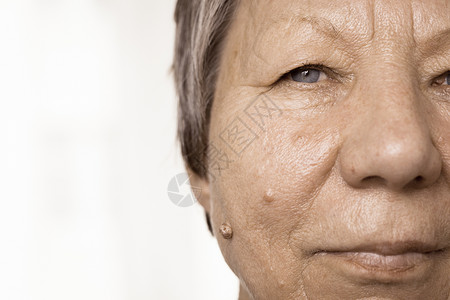 皮肤肿瘤老年养恤金领取者女脸颊合上背景